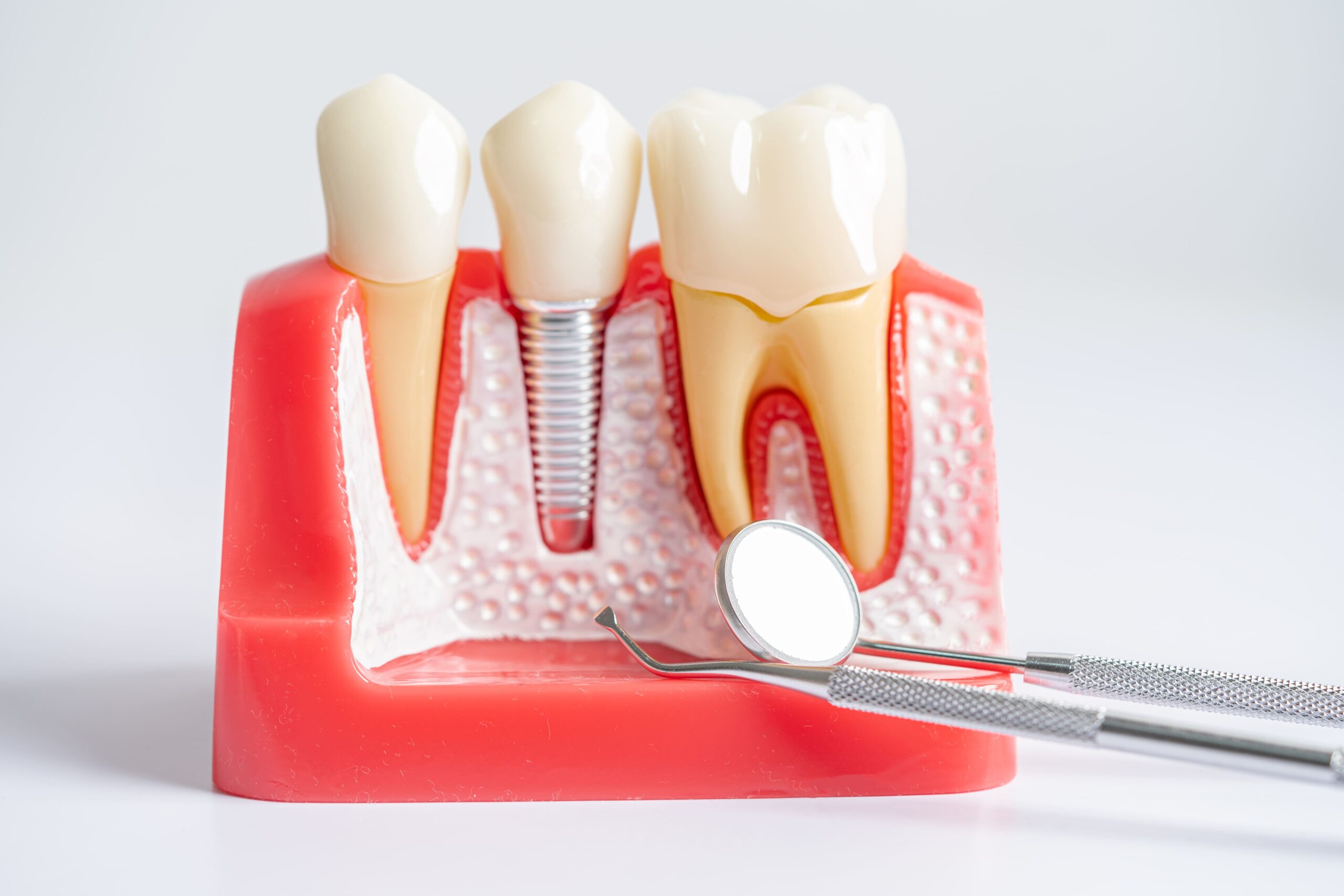 Implante dental de titanio insertado en maqueta anatómica de mandíbula, mostrando su integración en el hueso