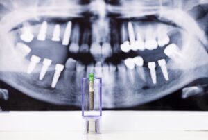 Radiografía dental en la que se aprecia un implante integrado en el hueso maxilar, destacando su correcta colocación
